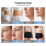 www.hktmay.com_vacuum rf roller_TM-926_06_Vacuum RF Roller Cellulite Removal Machine_Treatment area
