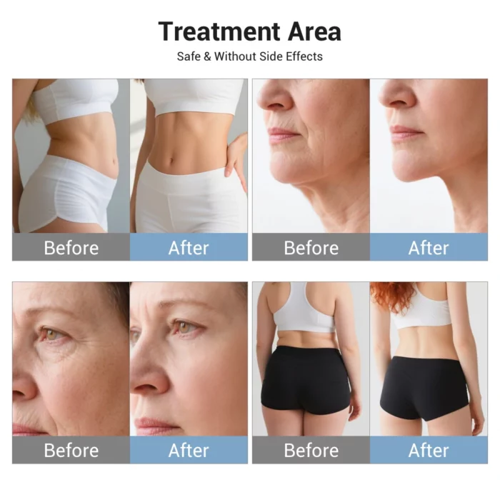 www.hktmay.com_vacuum rf roller_TM-926_06_Vacuum RF Roller Cellulite Removal Machine_Treatment area